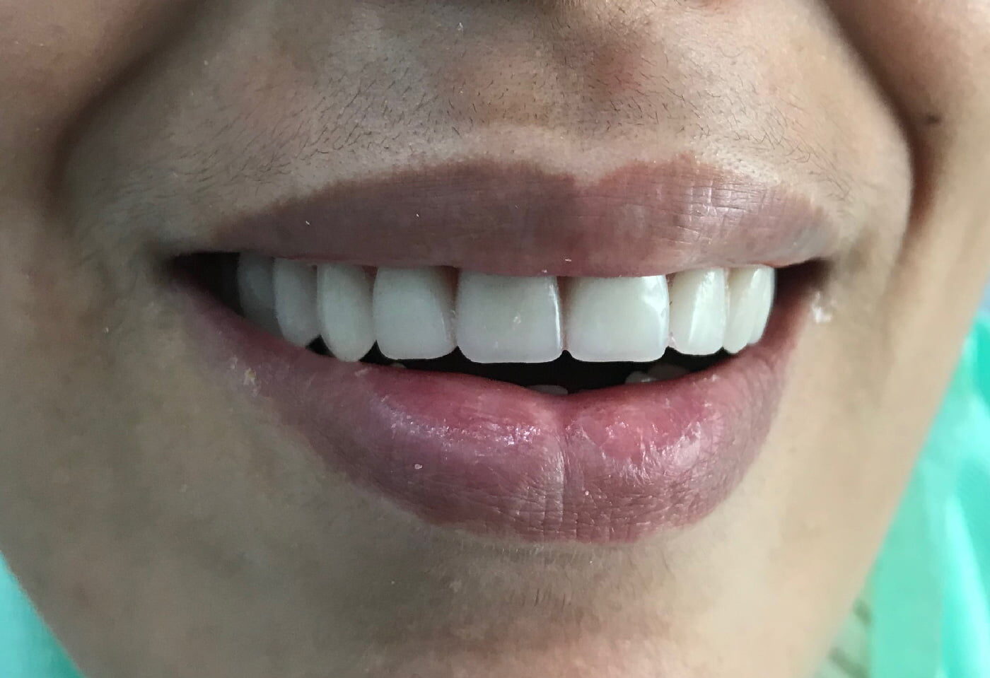 Dents après traitement avec prothèse dentaire, hollywood smile avec facettes et implant dentaire à Cheraga, Alger en Algérie