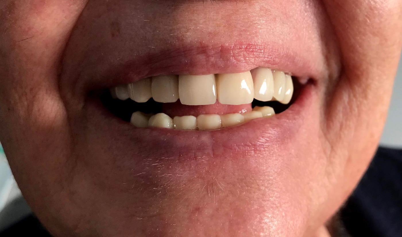 Dents après traitement avec prothèse dentaire, hollywood smile avec facettes et implant dentaire à Cheraga, Alger en Algérie