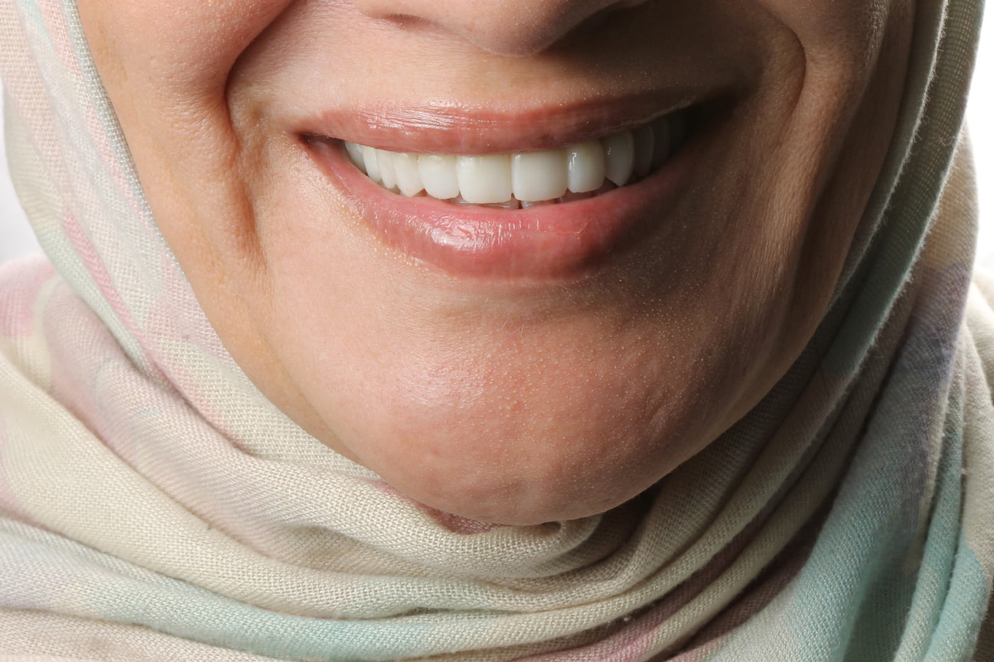 Dents après traitement avec prothèse dentaire, hollywood smile avec facettes et implant dentaire à Cheraga, Alger en Algérie$