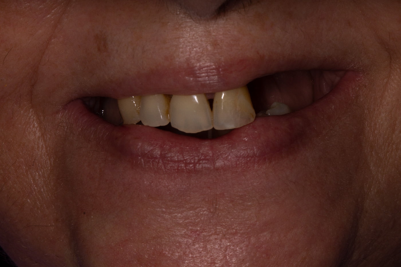 Dents manquantes avant traitement au cabinet dentaire MC Dental Concept à Cheraga, Alger en Algérie