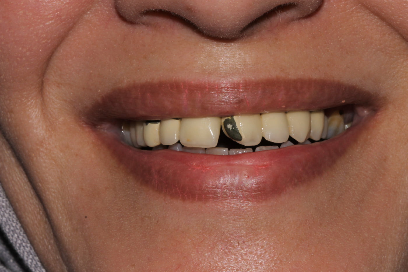 Dent cassée avant traitement au cabinet dentaire MC Dental Concept à Cheraga, Alger en Algérie