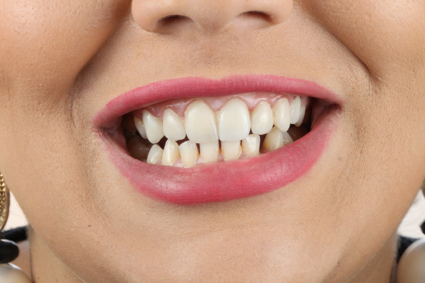 Dents avant traitement avec prothèse dentaire, hollywood smile avec facettes et implant dentaire à Cheraga, Alger en Algérie