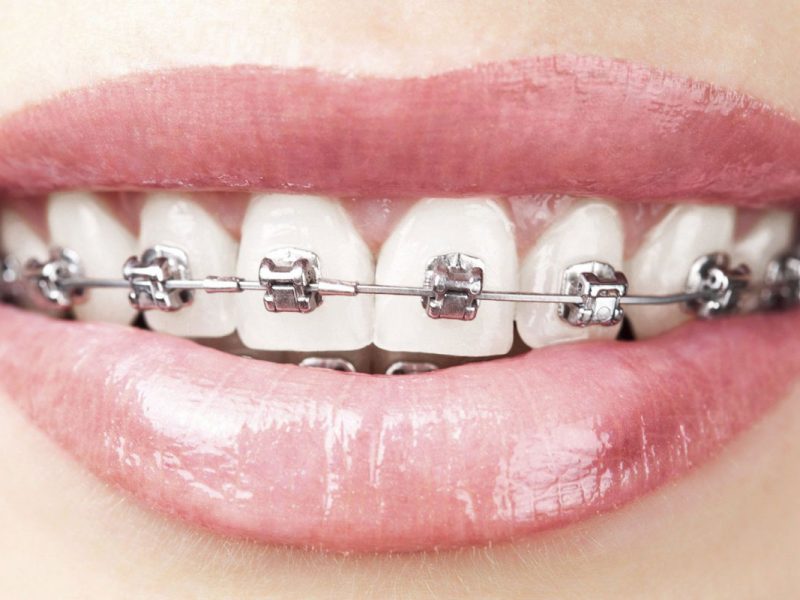 orthodontiste, appareil dentaire métallique et appareil dentaire transparent (en céramique) diagnostic, prévention des mâchoires mal positionnées et des dents mal alignées