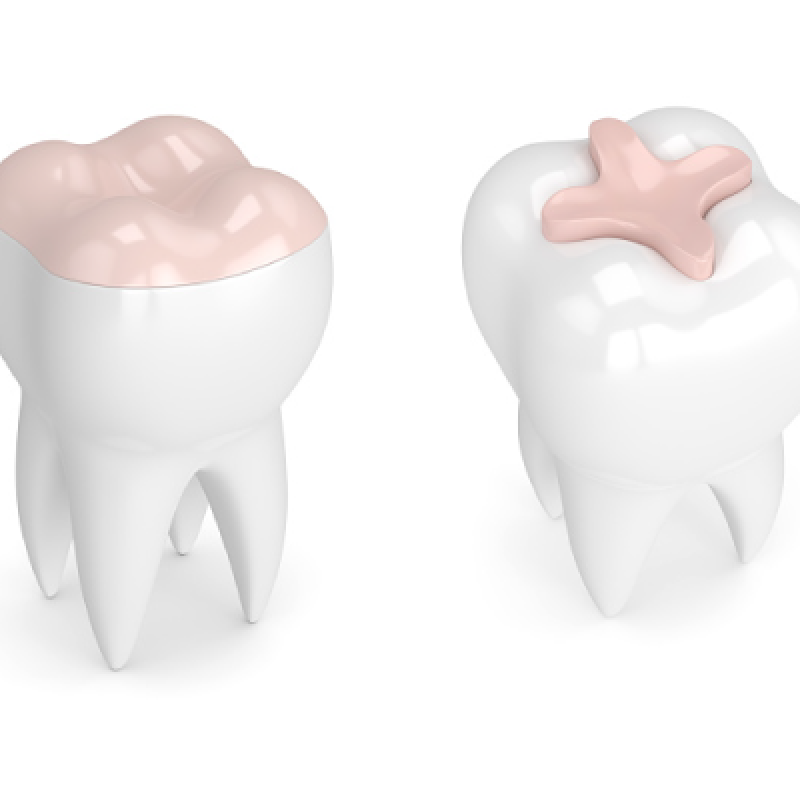 Inlay-onlay Prothèse dentaire amovible et fixe : couronne dentaire, bridge dentaire au Cabinet dentaire MC dental concept à Cheraga, Alger en Algérie